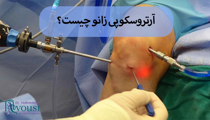 آرتروسکوپی زانو
