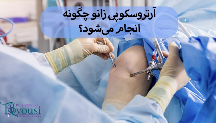 بعد از آرتروسکوپی زانو چه انتظاری باید داشته باشیم؟
