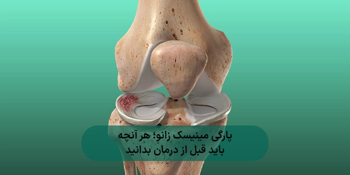 پارگی مینیسک زانو؛ هر آنچه باید قبل از درمان بدانید