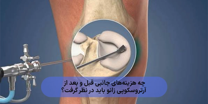 هزینه آرتروسکوپی زانو برای درمان پارگی مینیسک و رباط چقدر است؟