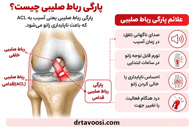پارگی رباط صلیبی
